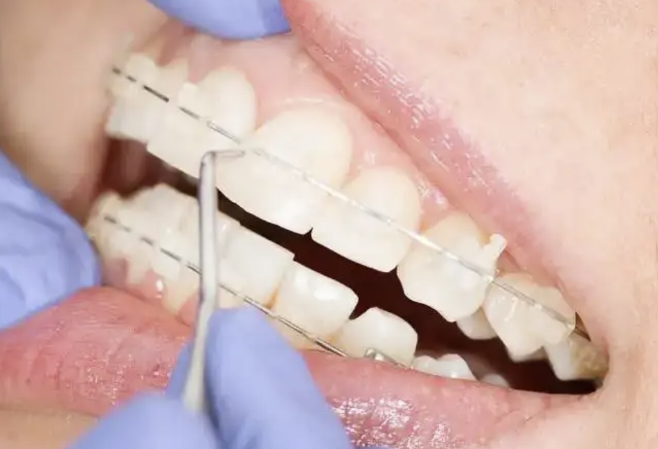 Tips Mengatasi Gigi Renggang dengan Kawat